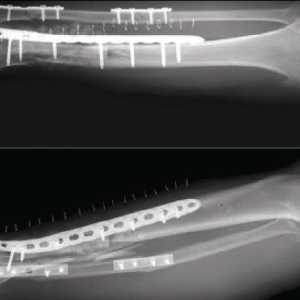 Medical Bone Fracture Application