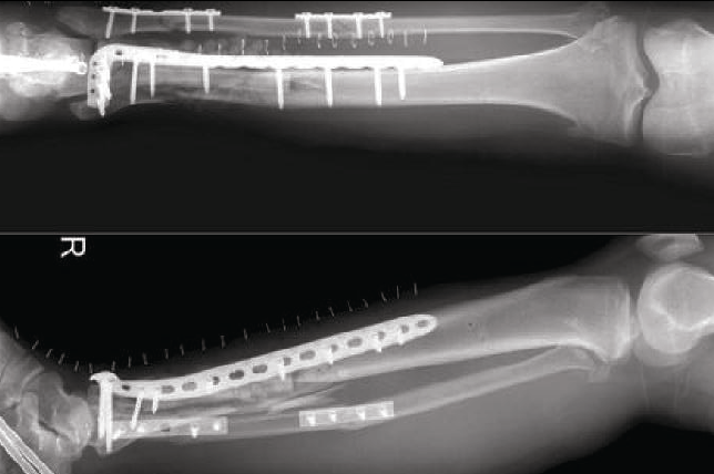 Medical Bone Fracture Application