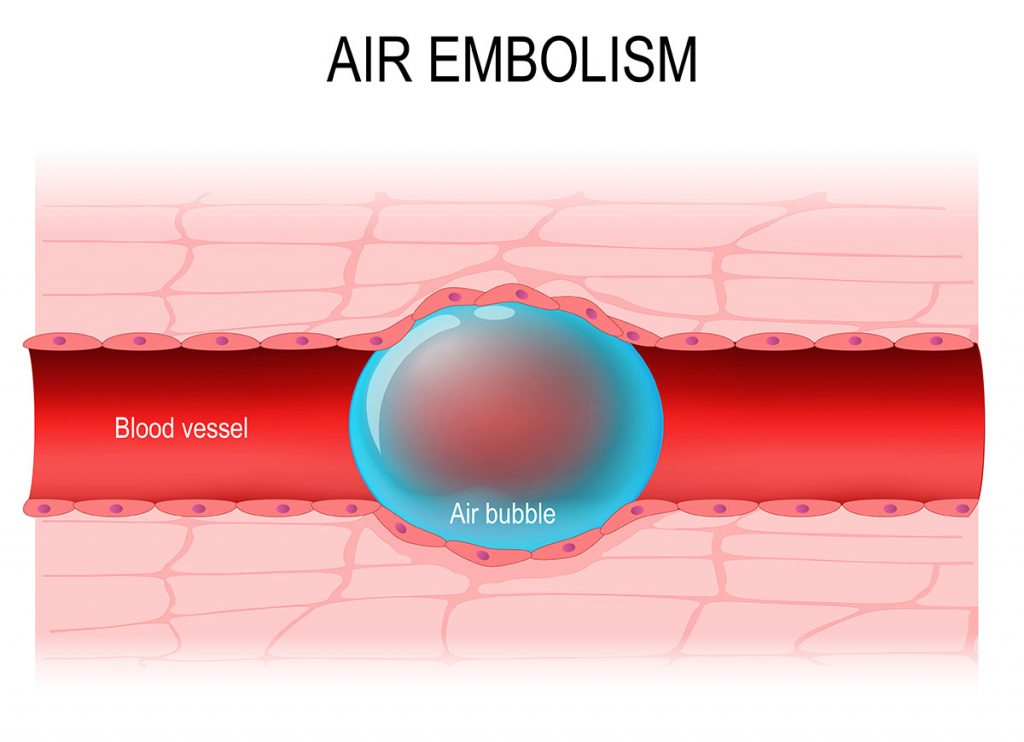 preventing air embolisms