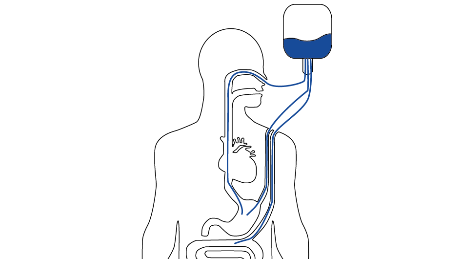 sensors for medical internal feeding pumps